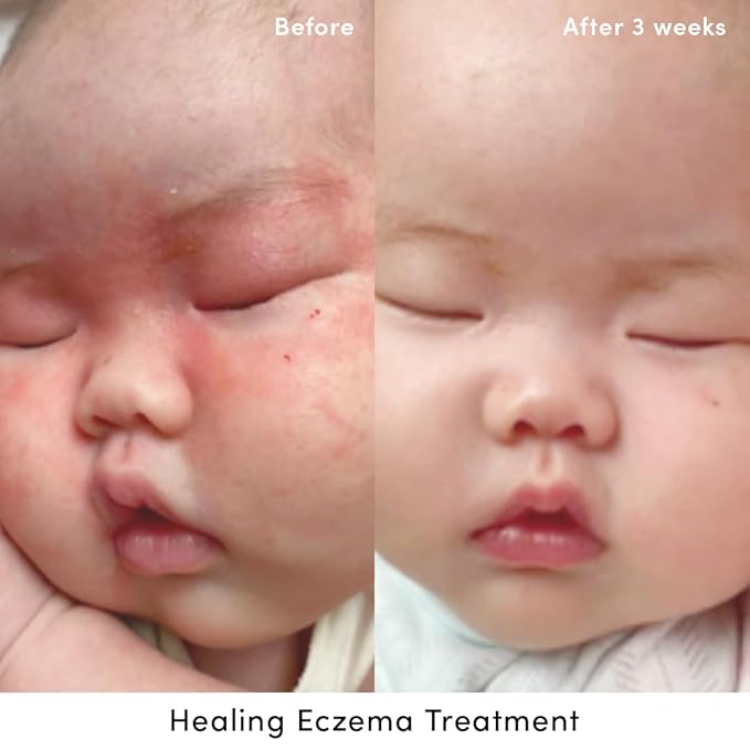 Evereden Healing Eczema Treatment, 1.7 fl oz & Nourishing Baby Face Cream 1.7 oz.| Fragrance Free Eczema Cream for Babies, Kids, and Adults | Non-Greasy Baby Moisturizing Cream | Clean Ingredients