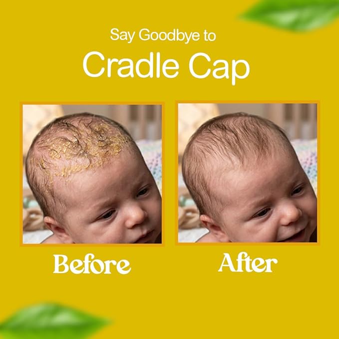 Bella B Bee Gone Cradle Cap Shampoo 8oz (2-Pack), Natural & Organic Baby Shampoo Made with Aloe Vera, Oatmeal & Vitamin E | Ideal for Cradle Cap Treatment, Natural Dry Scalp Treatment & Hypoallergenic