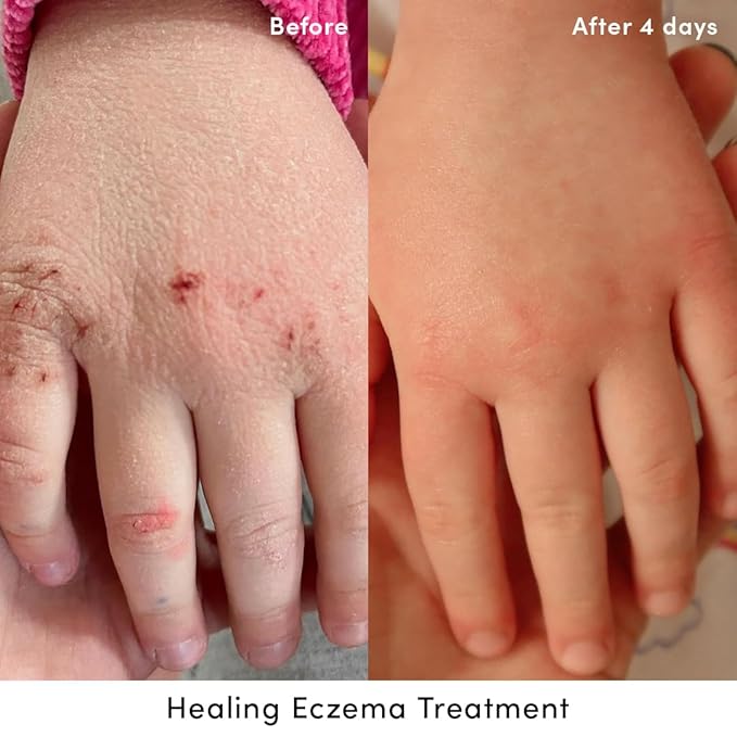 Evereden Healing Eczema Treatment, 1.7 fl oz & Nourishing Baby Face Cream 1.7 oz.| Fragrance Free Eczema Cream for Babies, Kids, and Adults | Non-Greasy Baby Moisturizing Cream | Clean Ingredients