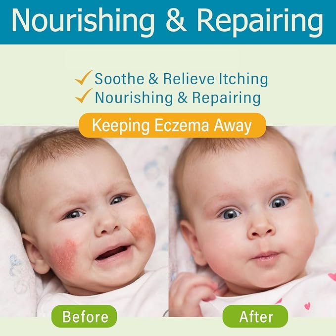 AOAO Baby Eczema Cream - Kids Eczema Therapy & Relief Body Cream, Nourishing Skin Protectant Soothes & Relieves Dry, Hypoallergenic, Fragrance & Steroid-Free (100ml, Fl Oz, 3.38) (White+)