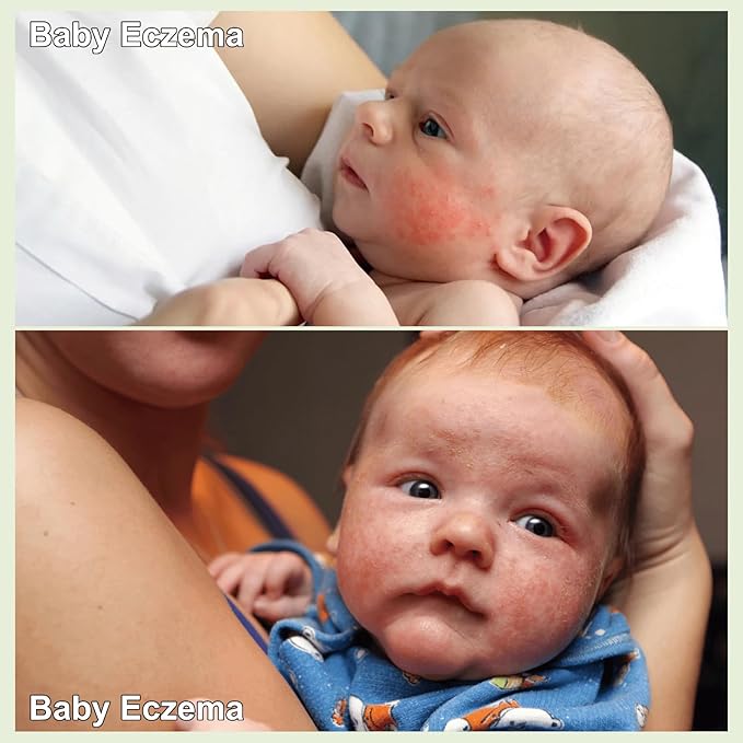 AOAO Baby Eczema Cream - Kids Eczema Therapy & Relief Body Cream, Nourishing Skin Protectant Soothes & Relieves Dry, Hypoallergenic, Fragrance & Steroid-Free (100ml, Fl Oz, 3.38) (White+)