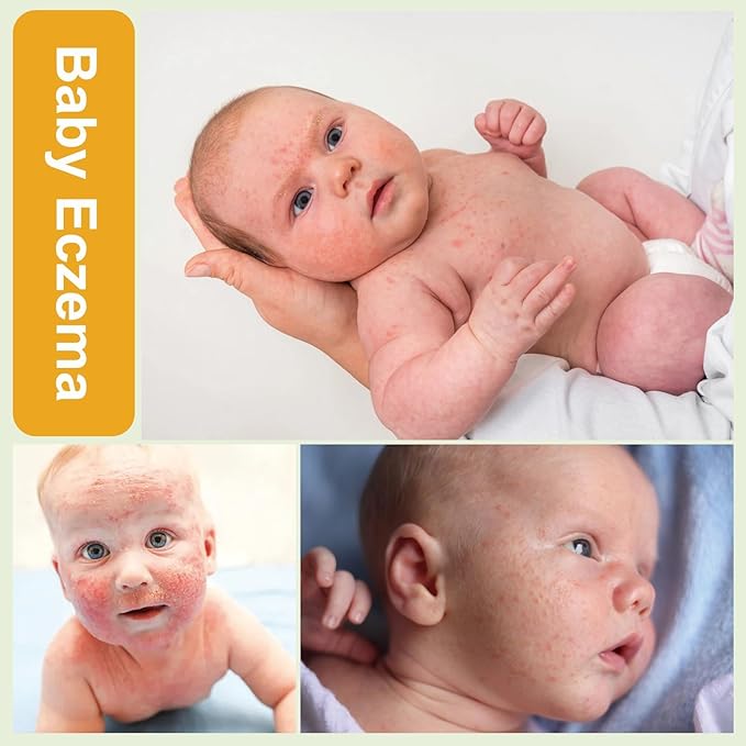 Heat Rash Care Cream for Babies | Prevents Prickly Heat, Sweat Rashes, Eczema & Skin Inflammation | Alleviating Discomfort for Babies Skin | 100ml/3.38oz (100ml/1pack)