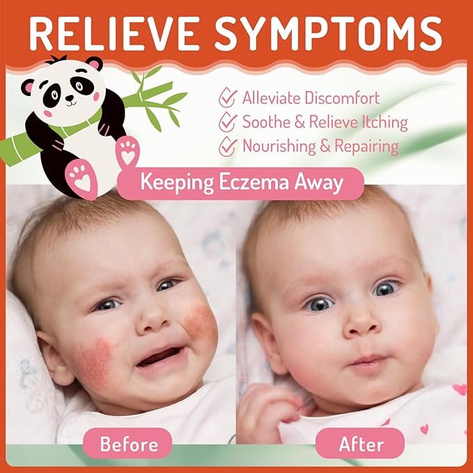 Baby Eczema Cream for Kids, Eczema Therapy & Relief Body Lotion - Nourishing Skin Protectant, Soothes Dry Irritated Skin, Hypoallergenic & Steroid-Free, 100ml/3.38oz