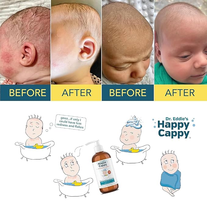 Happy Cappy Medicated Shampoo and Body Wash- Baby Dandruff Shampoo, Helps Cradle Cap and Seborrheic Dermatitis, Reduces Flakes and Redness, Dermatologist Tested, Fragrance-Free - 8 Fl Oz